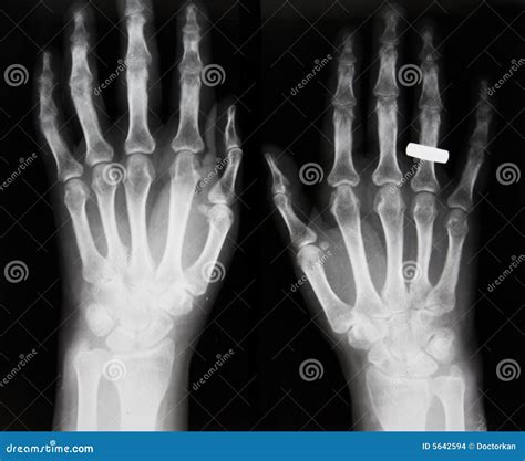 Severe Osteoporosis X Ray