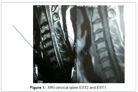 Cervical Nerve Roots Mri