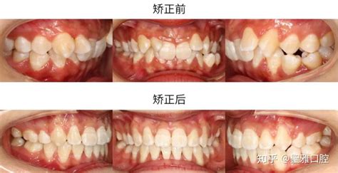 拔牙矫正 一次拔四颗多不多？ 知乎