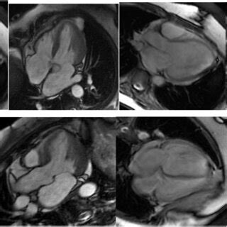 Cardiac Magnetic Resonance Image Of Noncompaction Left Ventricle With