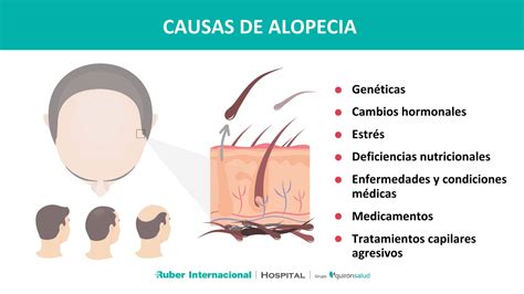 O Que Que É Alopecia - Alopecia: Qué es. Cómo se diagnóstica. Cuál es su tratamiento.