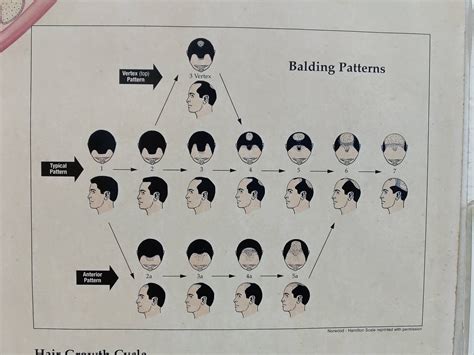 Balding patterns : r/coolguides