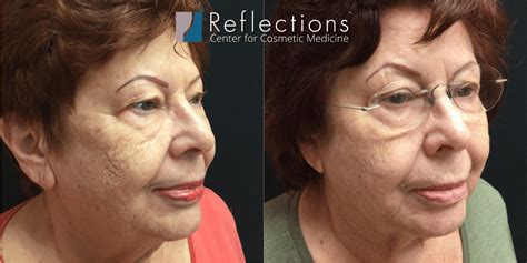 Exilis Ultra Non Surgical Face Lift Skin Tightening For Patient In