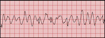 The Ballet of V-Fib: A Glimpse into the World of a Cardiac Critical ...