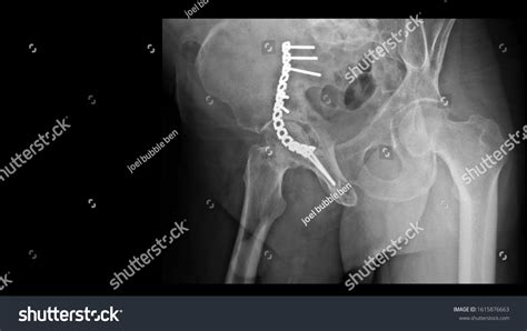 Film X Ray Hip Radiograph Show Stock Photo 1615876663 | Shutterstock