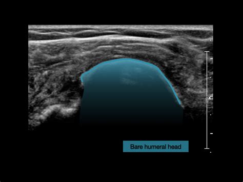 Complete Supraspinatus And Infraspinatus Tendon Tears And Dislocation