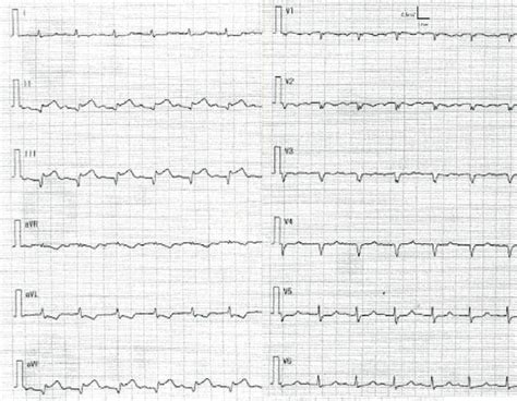 Figure An Electrocardiogram Obtained At The Emergency Department It