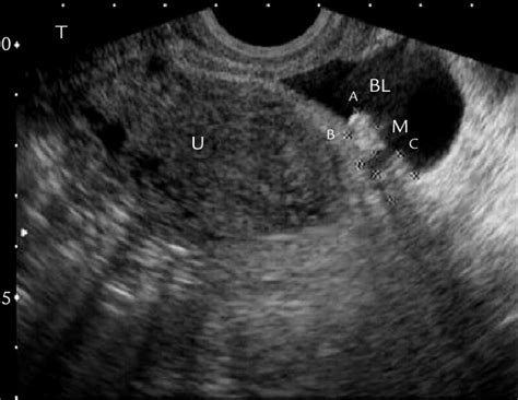 Transvaginal Sonography Shows An Echogenic Mass M 0 9 × 0 7 Cm In Download Scientific