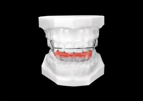 Bionator Appliance Universal Orthodontic Lab