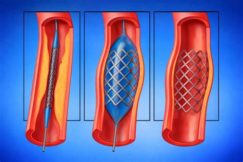 O Que E Angioplastia - Angioplastia: O Que é, Quando é Indicada E Como Funciona O Procedimento ...