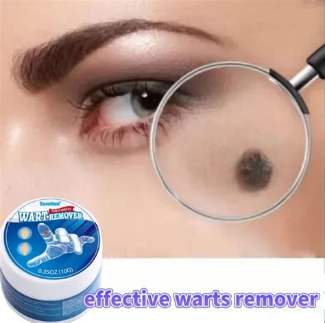 Warts Remover Original Cream Mole Skin Tags And Warts Remover Ointment