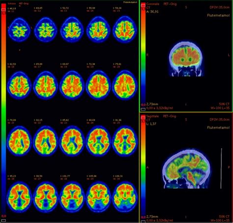 ¹⁸f Amyloid Petct In Sagittal And Coronal Views And Pet Only Scan In