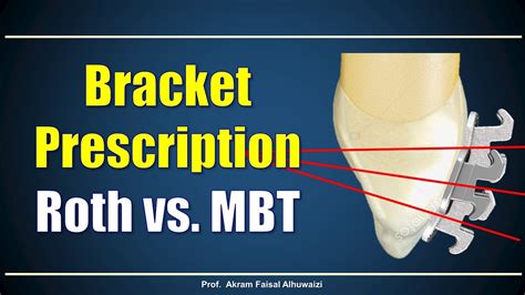 Using Roth And Mbt Brackets Youtube