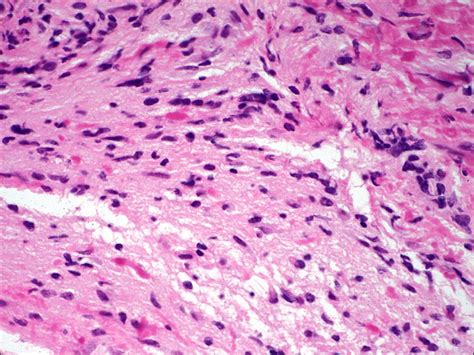 Moran Core Optic Nerve