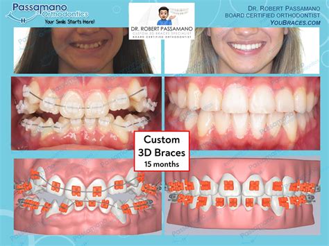 Braces Before And After Smile