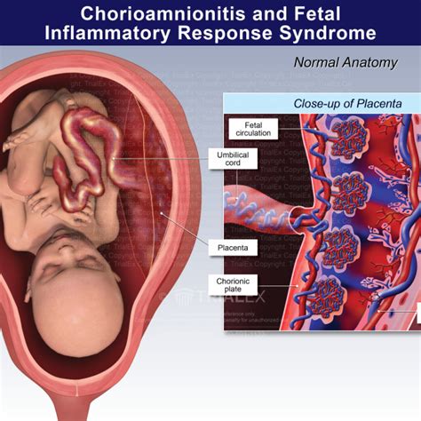 Chorioamnionitis And Fetal Inflammatory Response Syndrome