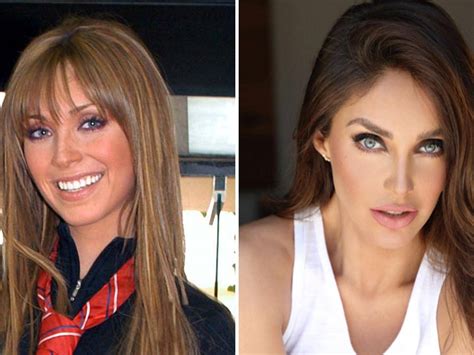 Anahi Antes Y Despues Dela Cirugia