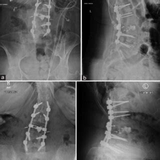 Standing Anteroposterior And Lateral Radiographs Of The Lumbar Spine