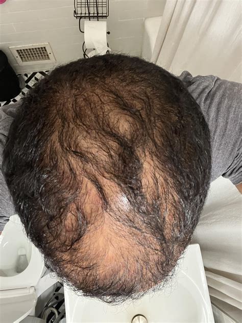 Just Bought Intelligent Ketoconzole Shampoo And Have Started Using It