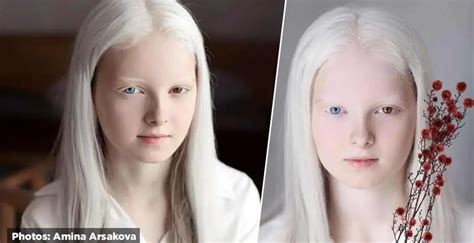 Heavenly Photoshoot Highlights The Unique Beauty Of A Girl With Albinism And Heterochromia