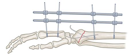 Mysurgery Unterarm Und Handgelenk