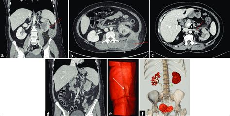 A Contrast Enhanced Abdominal Computed Tomography Obtained To