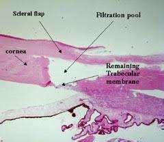 Sclérectomie Profonde Chirurgie Filtrante Chirurgie du Glaucome