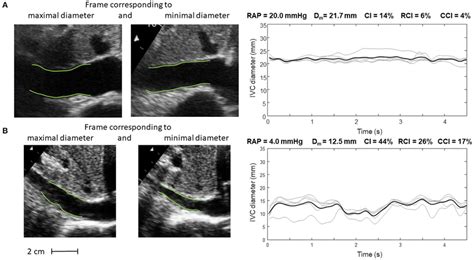 Inferior Vena Cava Ivc Dynamics In Patients With Different Right