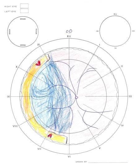 Scleral Buckle | 11.1 | Vitreoretinal Surgery