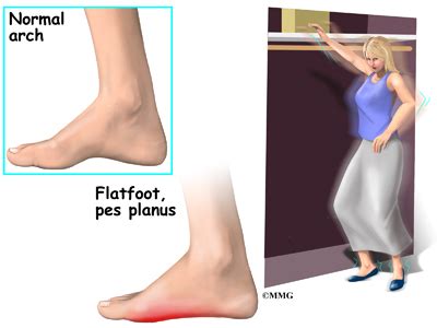 Adult Acquired Flatfoot Deformity | eOrthopod.com