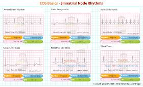 ECG Educator Blog Sinoatrial Node Rhythms