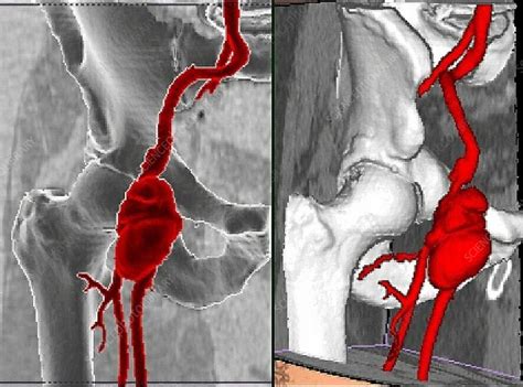 Right Femoral Infectious Aneurysm Ct Scan Stock Image C0353580
