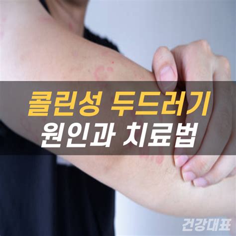 콜린성 두드러기 원인 치료