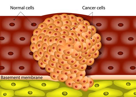 Tumores cutáneos malignos más frecuentes: ¿Cómo reconocerlos ... 