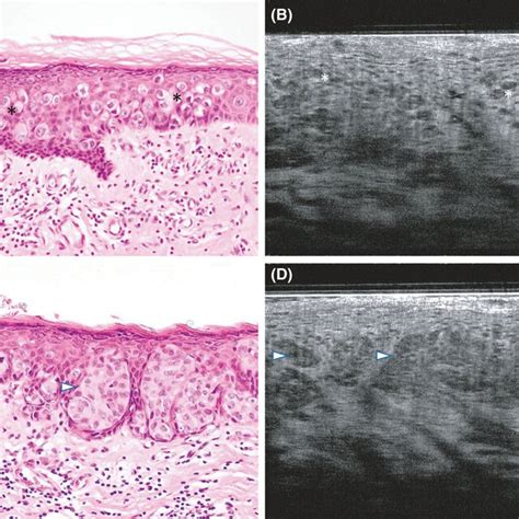 Extramammary Pagets Disease Case 1 A B Normal Skin Control From