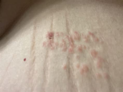 Shingles or something else? Weird lines of bumps. Was itchy, now