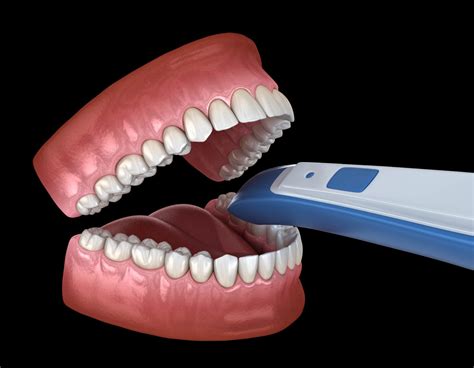 What Is An Intraoral Scan Digital Denture Implants Los Angeles Ca