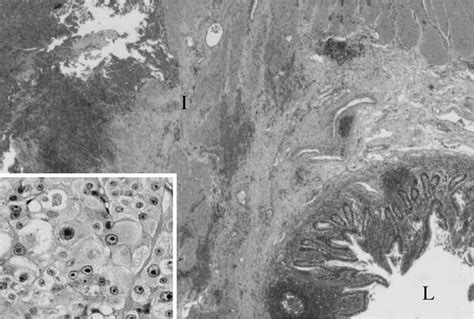 Figure 1 from Metastatic Hurthle cell carcinoma in the abdomen ...