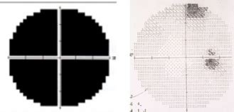 Junctional Scotoma and Junctional Scotoma of Traquair - EyeWiki