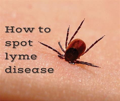 Ticks And Lyme Disease Know The Symptoms Of Lyme Disease Lyme Disease Lyme Disease