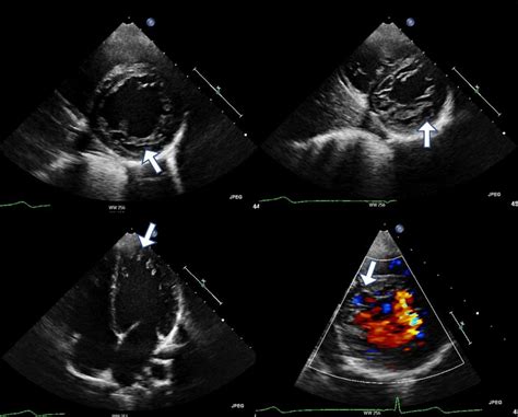 Transthoracic Echocardiogramcolor Doppler In Cross Sectional And 4