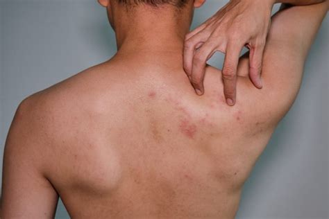 Eczema Psoriasis And Shingles Fldscc