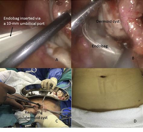 Dermoid Cyst Ovary Removal