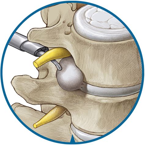 Foraminotomy