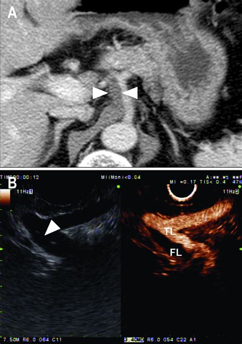 Computed Tomography Ct And Endoscopic Ultrasound Eus Findings In