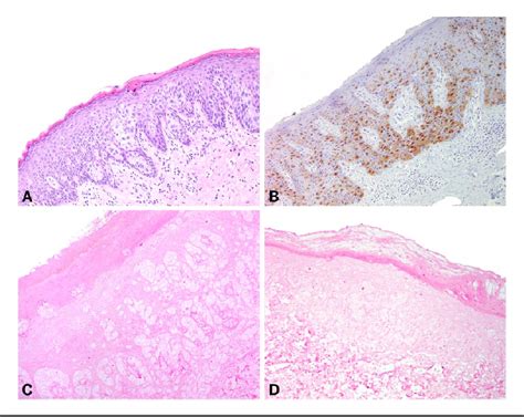 Figure 1 From P16 Expression In Extramammary Pagets Disease Of The