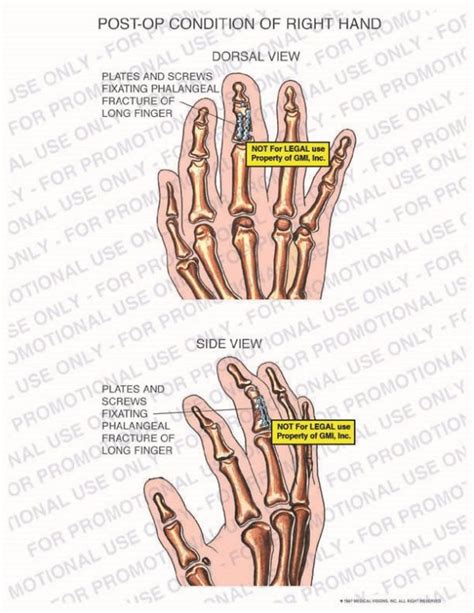 Post Op Condition Of Right Hand 97197a22b Generic Medical Legal Exhibits A Division Of Mvi