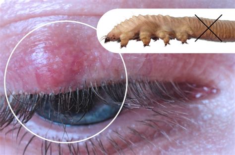 Eyelash Extensions Demodex And Blepharitis Ungex