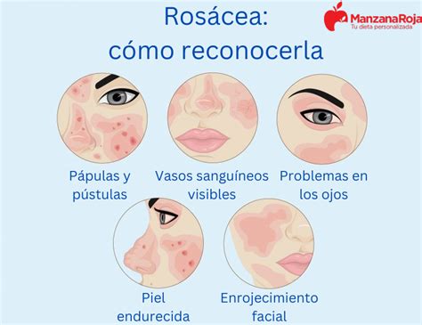 Rosácea Conoce Sus Causas Factores De Riesgo Y Tratamientos Efectivos