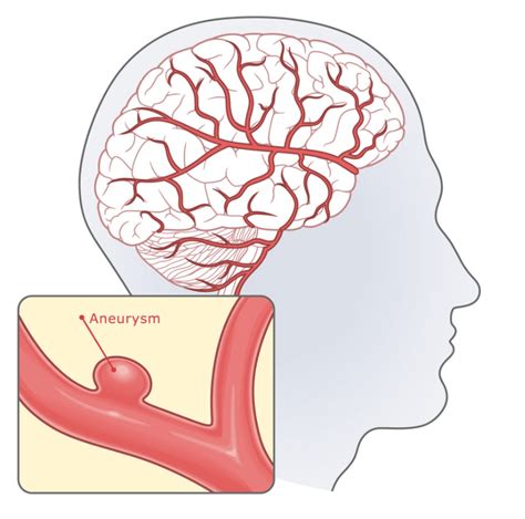 How To Prepare For Brain Aneurysm Coiling Procedure Supreme Vascular